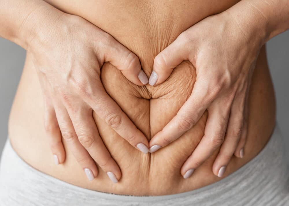Tratamientos para el abdomen arrugado después del embarazo