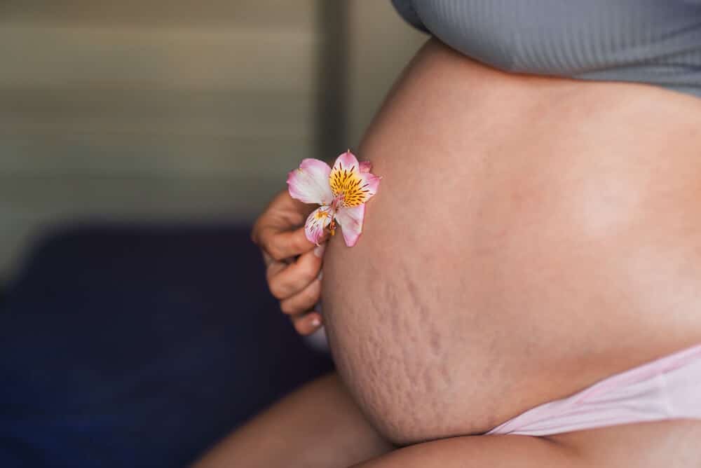 prevenir las estrías durante el embarazo